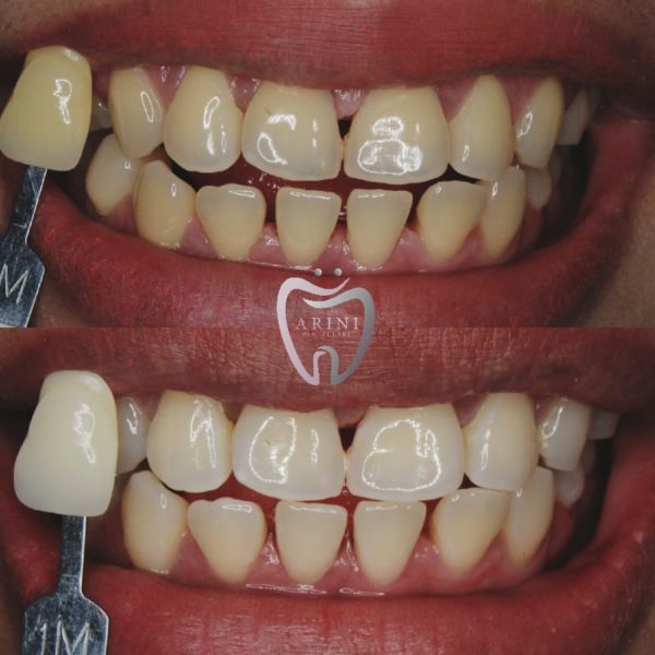 Penyebab Gigi Kuning dan Cara Melakukan Perawatan