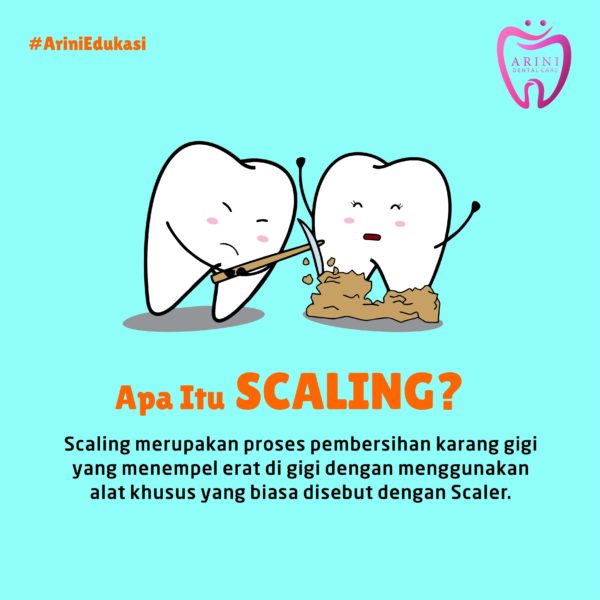 Apa itu Scaling gigi?