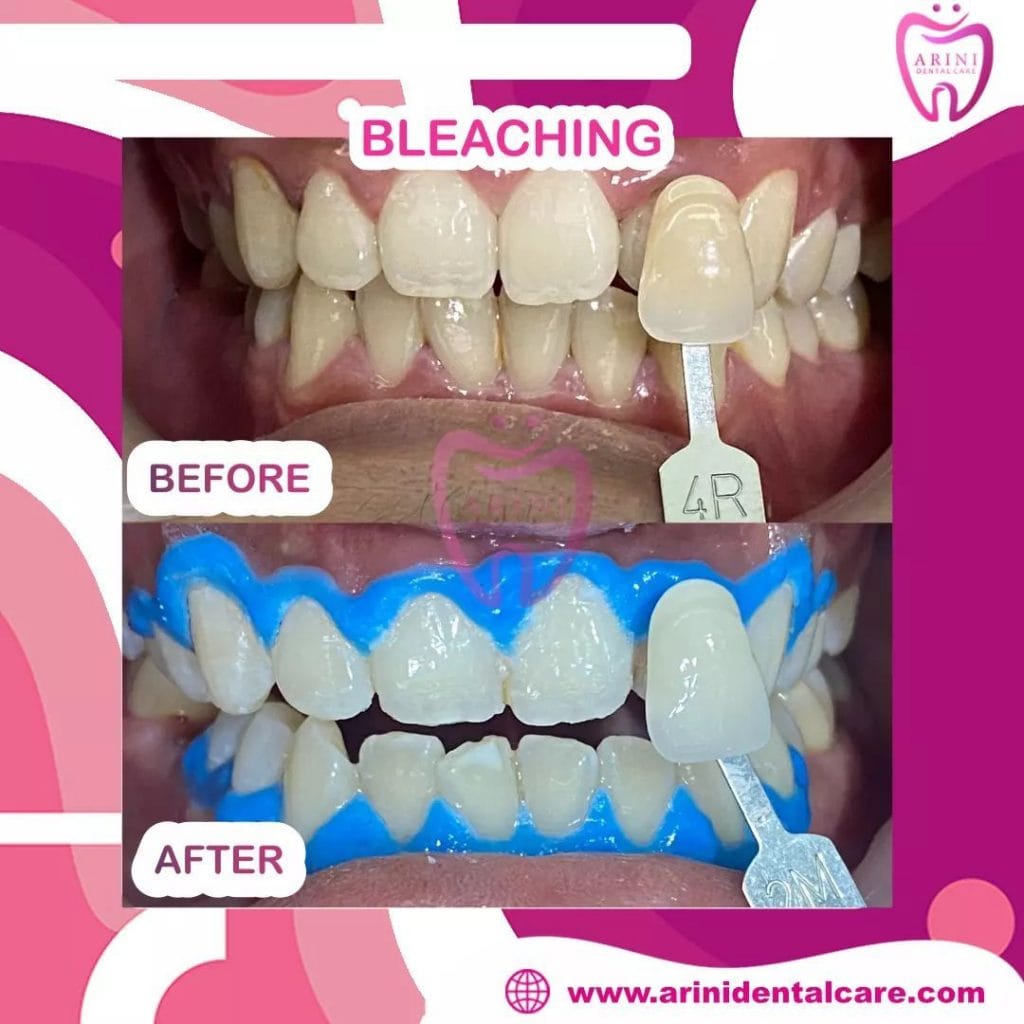 bleaching gigi arini dental care