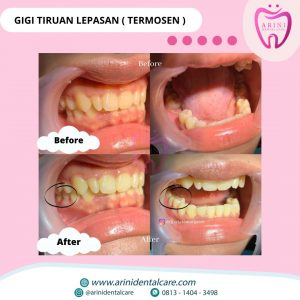 Gigi Tiruan Lepasan Dokter Gigi Terdekat Arini Dental Care