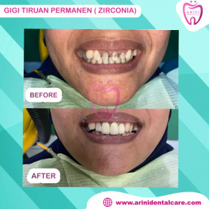 Gigi Tiruan Zirkonia Dokter Gigi Terdekat Arini Dental Care