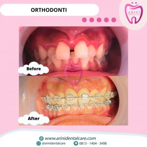 Ortho Klinik Gigi Terdekat Arini Dental Care