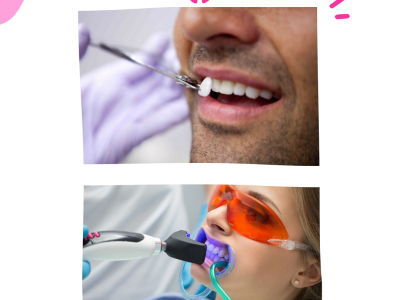 Perbedaan Treatment Gigi Veneer dan Bleaching