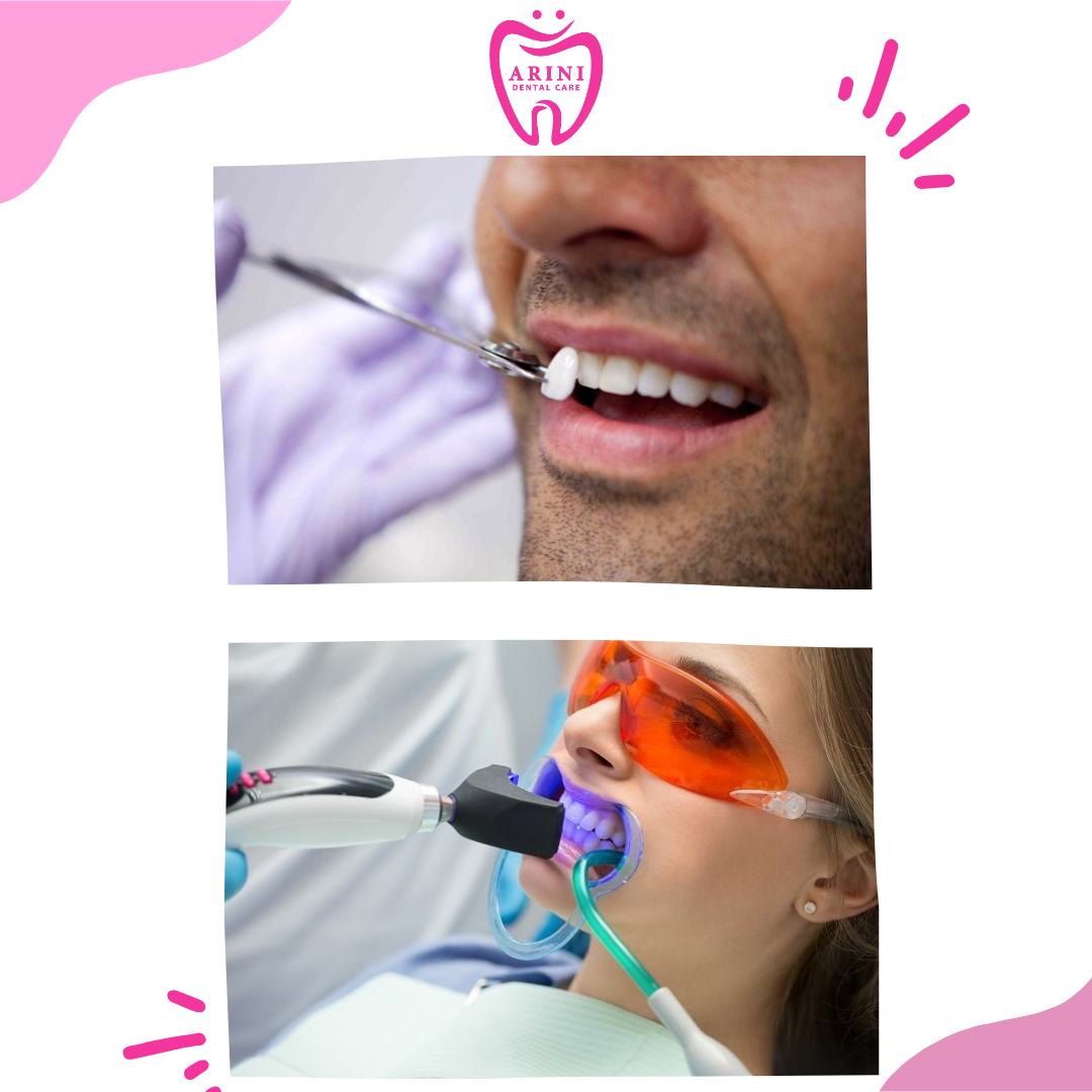 bleaching_veneer_arini dental care