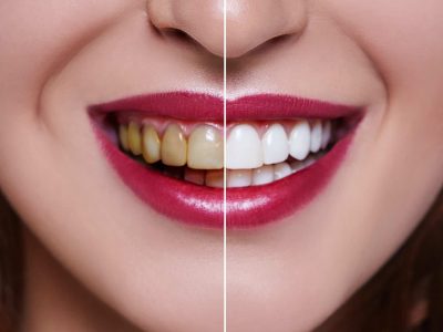 Tips Treatment Bleaching yang Tahan Lama