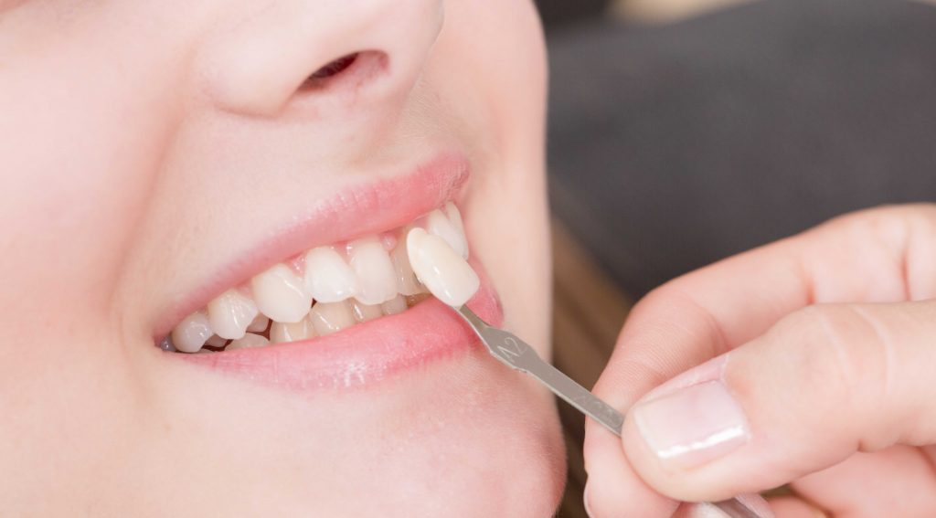 veneer-direct-veneer-indirect-arini-dental-care