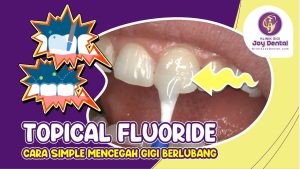 Apa itu fluoride dan bagaimana cara kerjanya pada gigi?