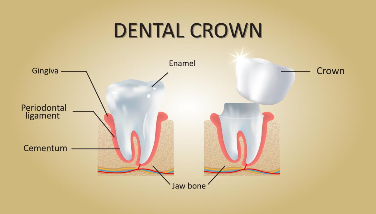 Complete Dental Crown Guide: Cost, Procedures, And Types Seperti apa bentuk crown gigi dan bagaimana prosedur pemasangan crown gigi