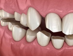 Hal apa saja yang bisa menyebabkan terkikisnya enamel gigi