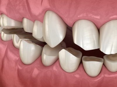 Ini Penyebab Utama Terkikisnya Enamel Gigi dan Cara Melindunginya