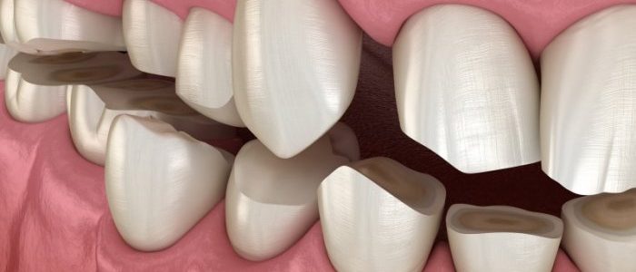 Ini Penyebab Utama Terkikisnya Enamel Gigi dan Cara Melindunginya